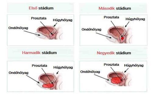 prostate cancer stages 5 Tabletták a prostatitis omnik kezelésére